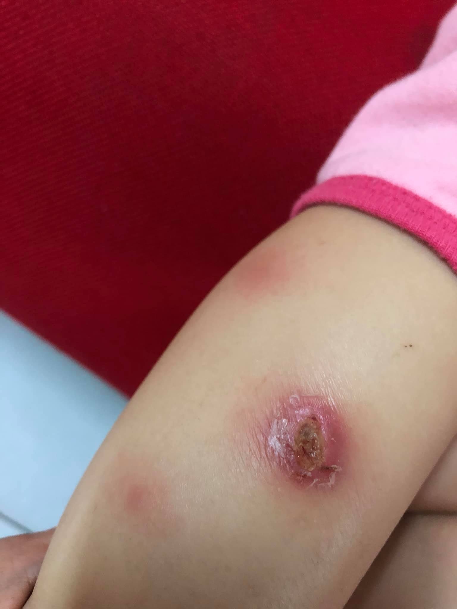 近日在马来西亚,有妈妈就在网上分享,表示早前女儿被昆虫咬伤,但因为