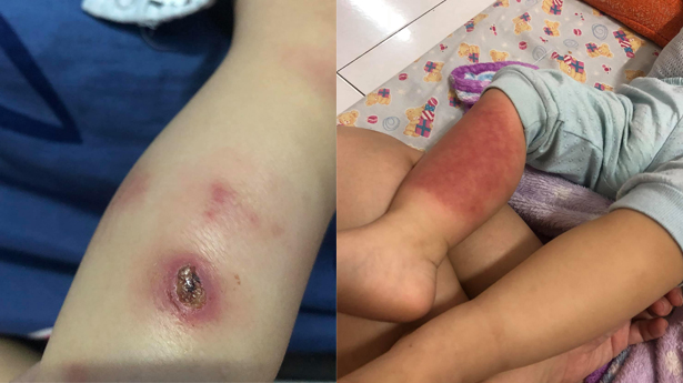 表示早前女儿被昆虫咬伤,但因为未有好好处理伤口,结果引致含脓发炎
